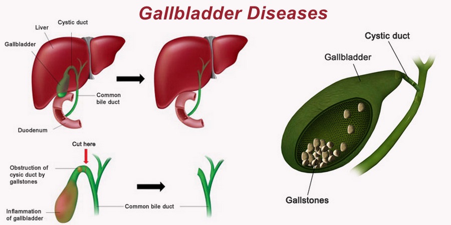 gallbladder-disease-types-diagnosis