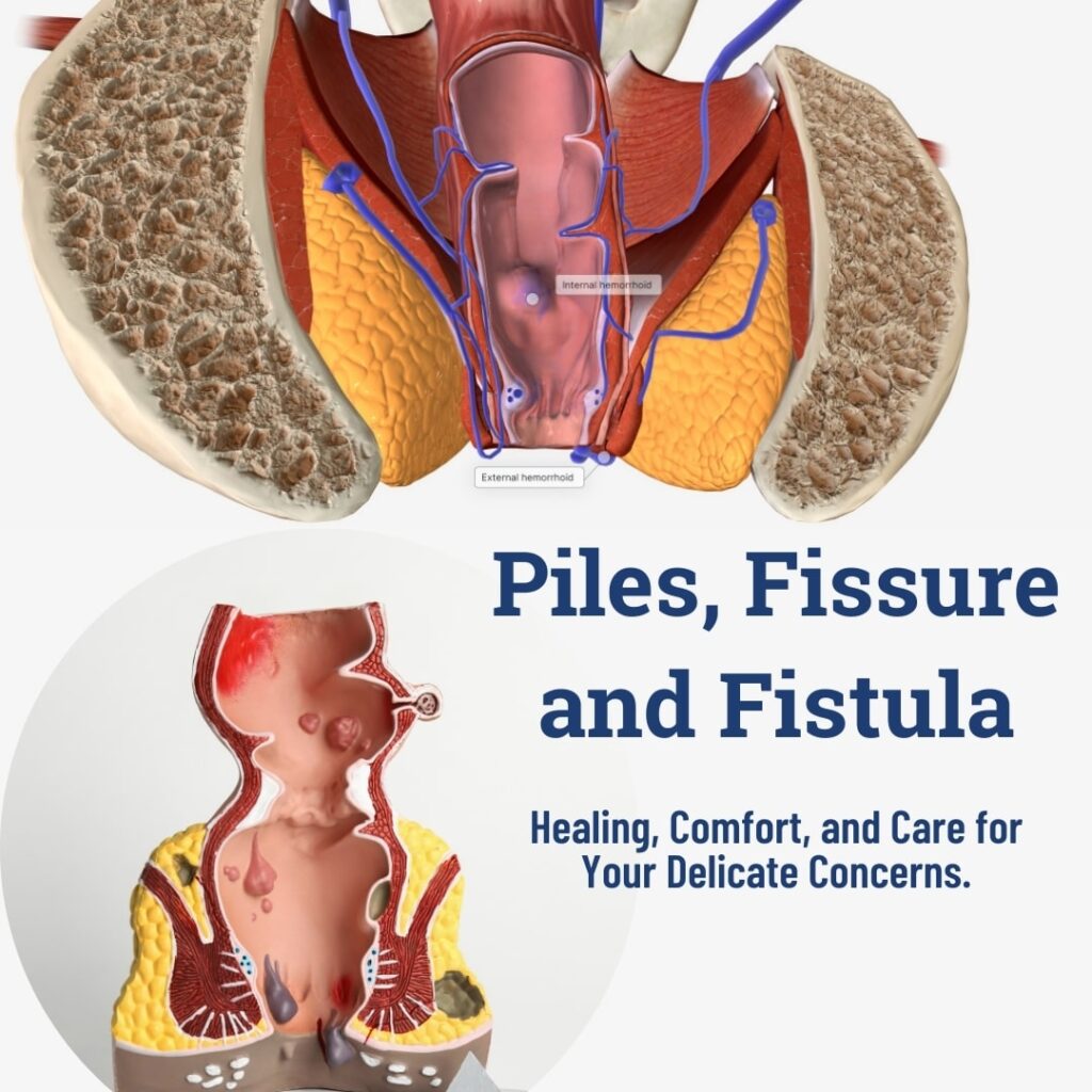 Piles, Fissure and Fistula