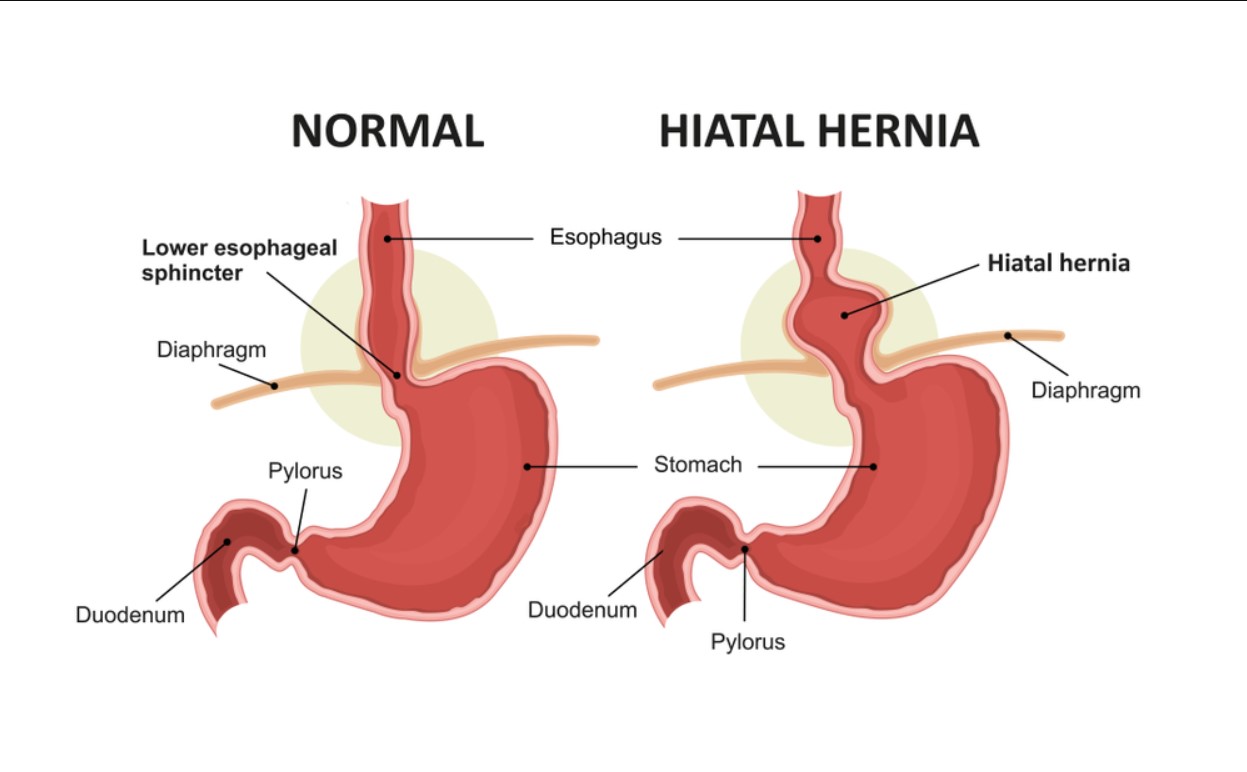 hiatal hernia vs normal