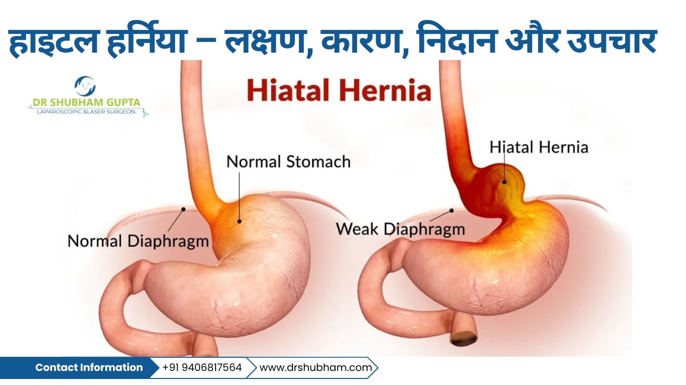 hiatal hernia case