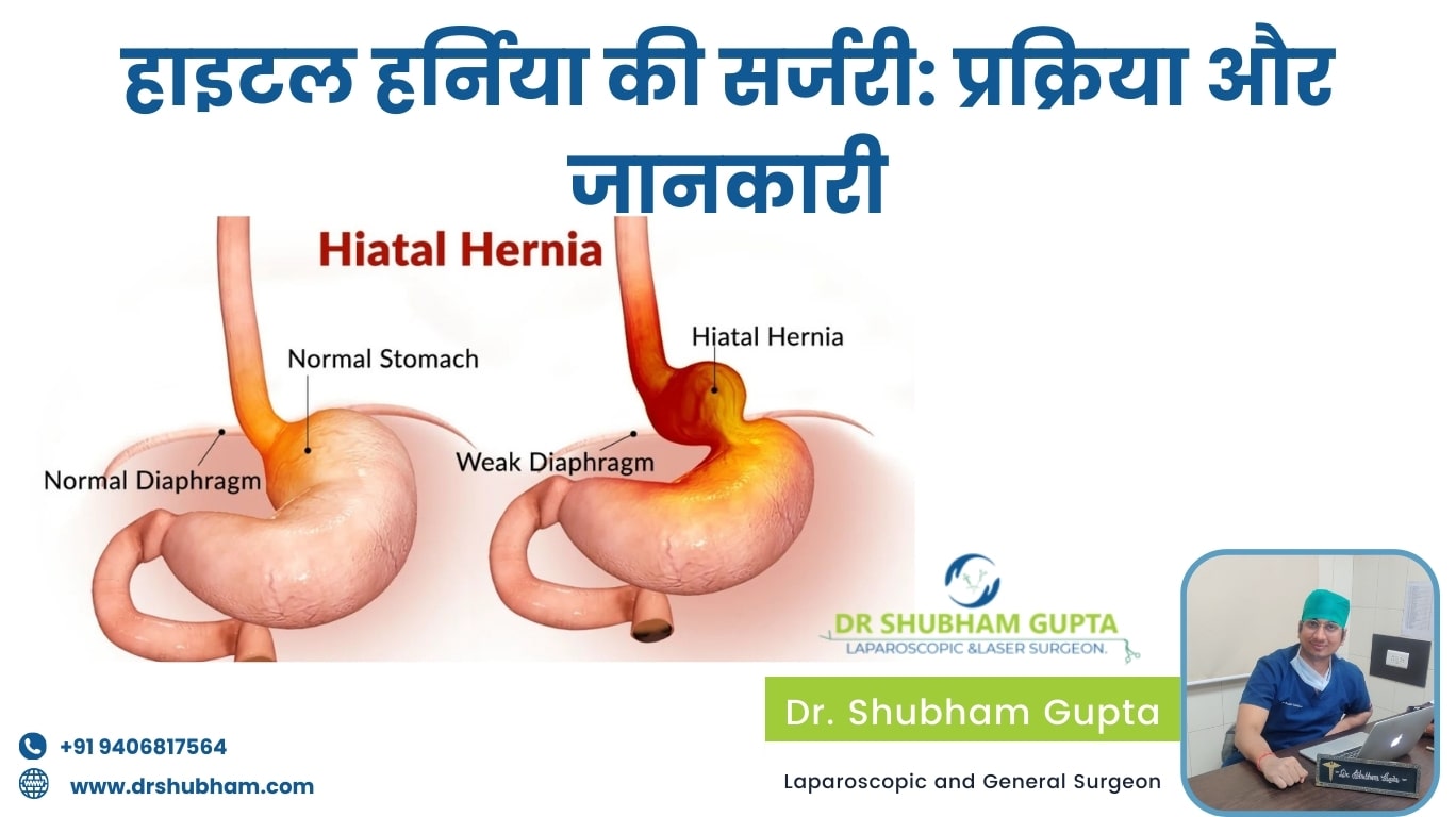 procedure related to hiatal hernia surgery