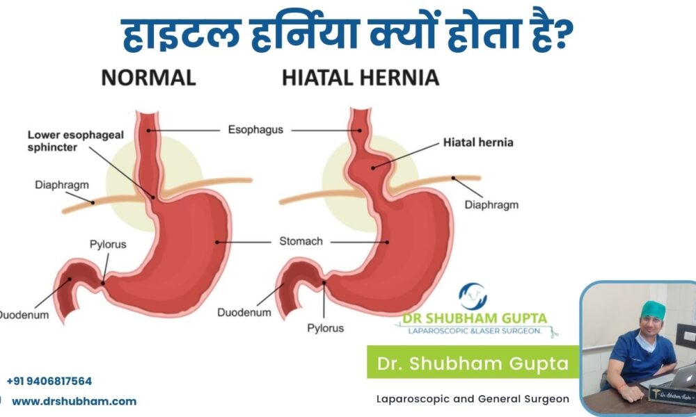 Why does hiatal hernia occur?