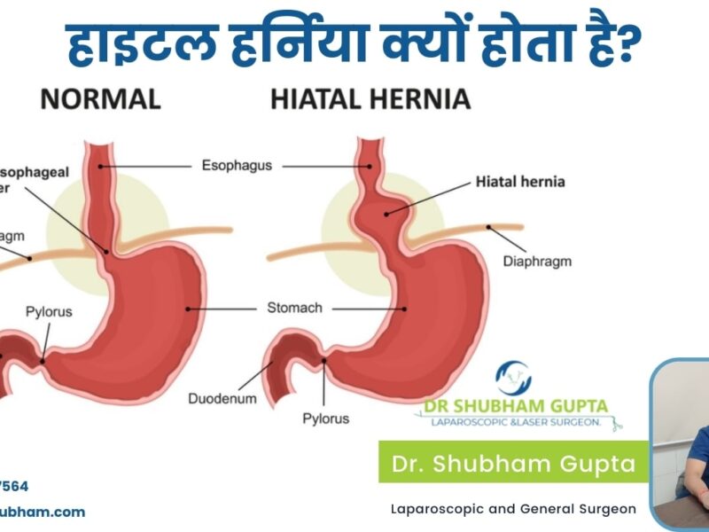 हाइटल हर्निया क्यों होता है?