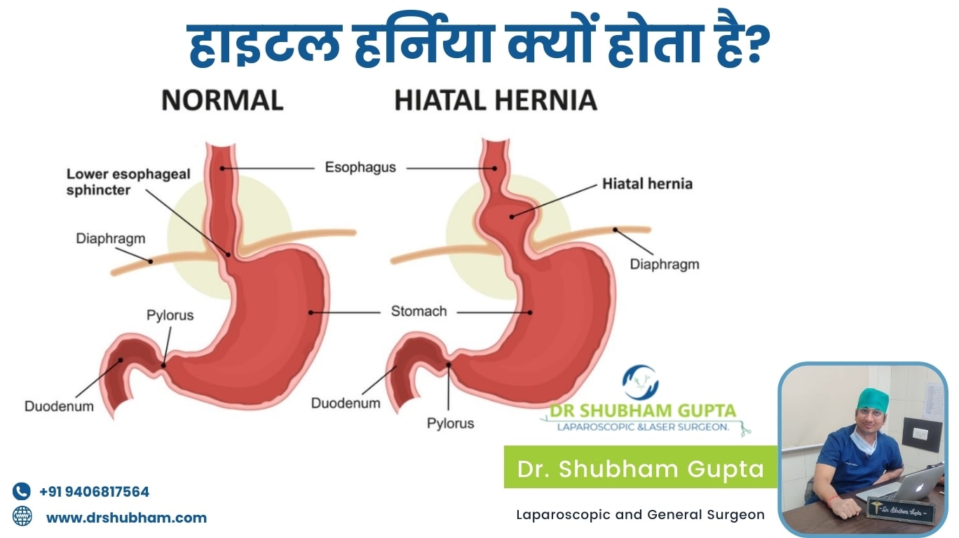 Why does hiatal hernia occur?