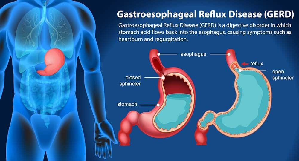 Acid-Reflux