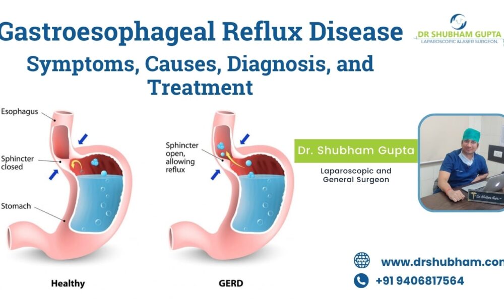 Gastroesophageal reflux disease