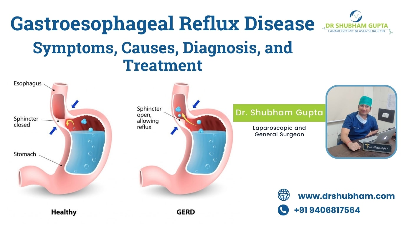 Gastroesophageal Reflux Disease – Symptoms, Causes, Diagnosis, and Treatment