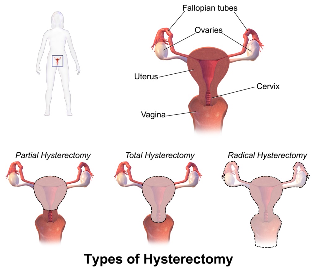 Laparoscopic Hysterectomy3