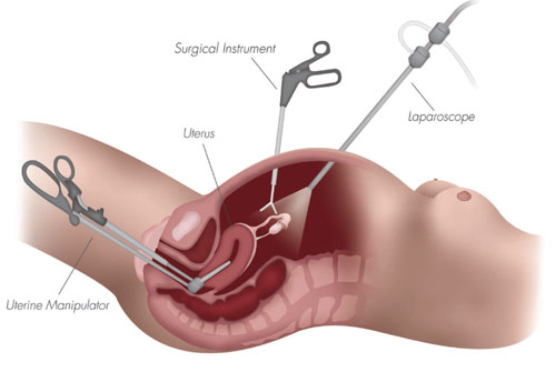 Laparoscopic Hysterectomy