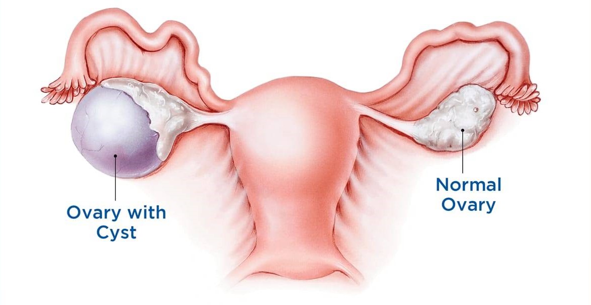 ovarian-cystectomy