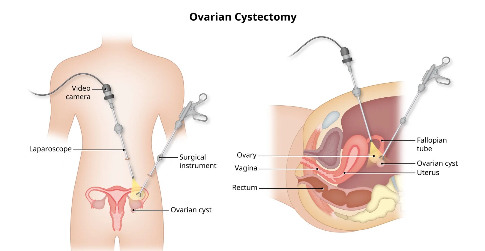 ovarian-cystectomy_1