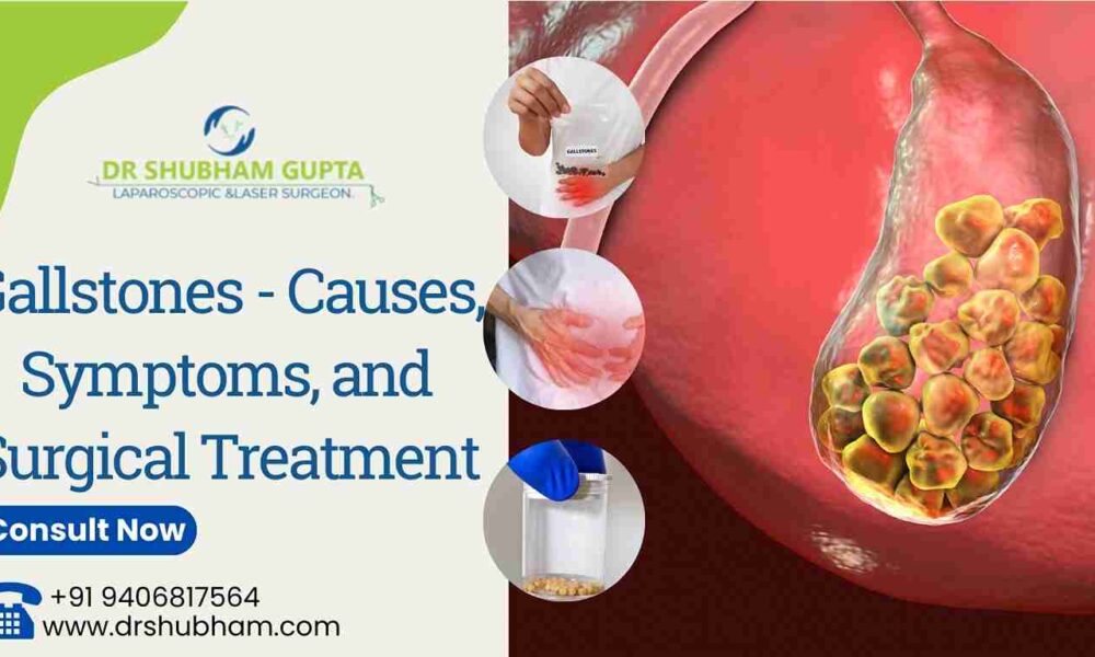 Gallstones - Causes, Symptoms, and Surgical Treatment