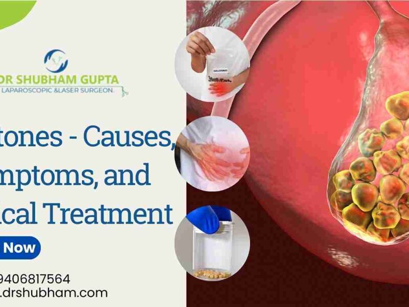 Gallstones – Causes, Symptoms, and Surgical Treatment