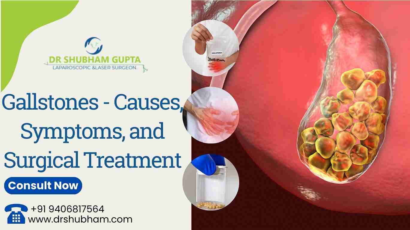 Gallstones – Causes, Symptoms, and Surgical Treatment