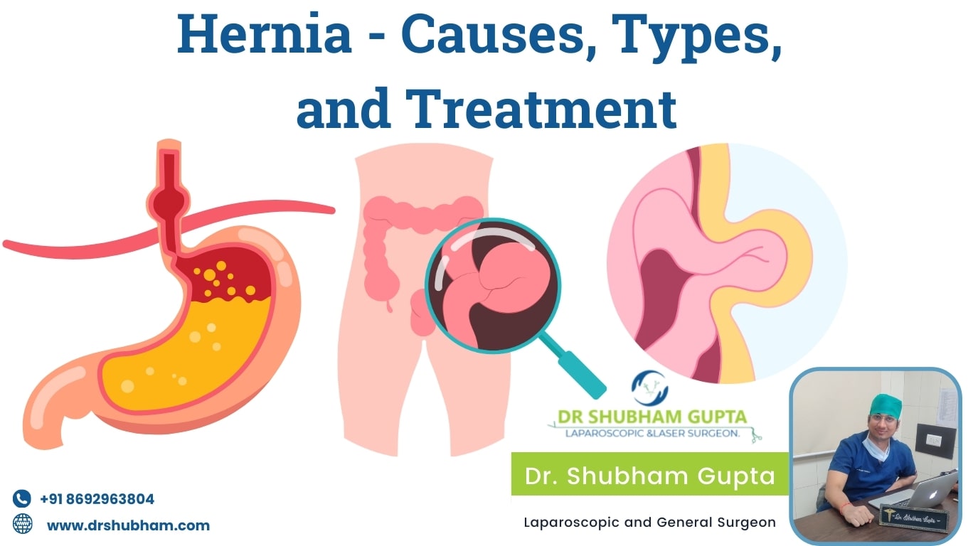 Understanding Hernia: Causes, Types, and Treatment