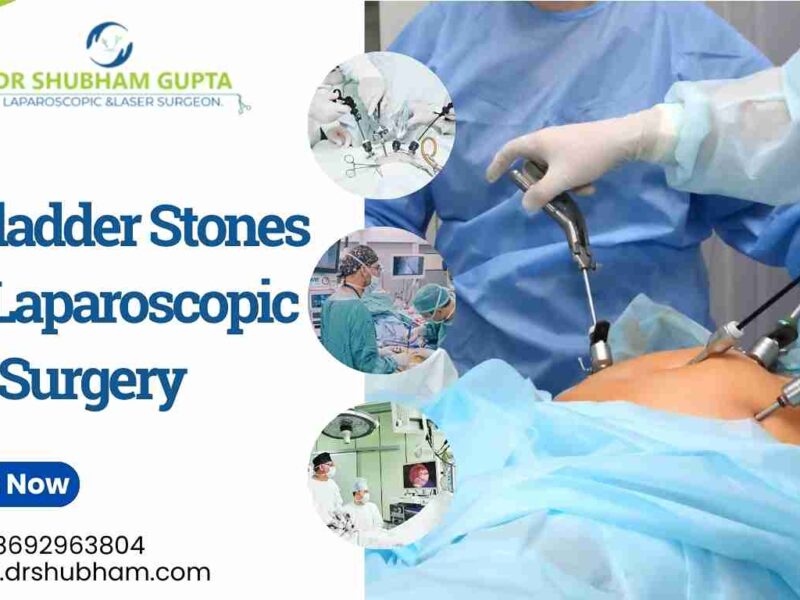 Gallbladder Stones and Laparoscopic Surgery | Dr. Shubham Gupta