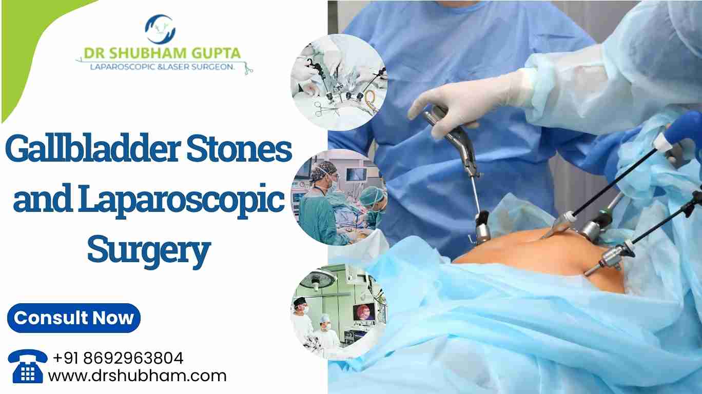 Gallbladder Stones and Laparoscopic Surgery | Dr. Shubham Gupta