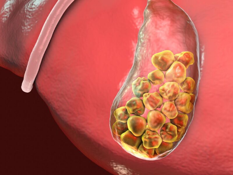 What are Gallstones? It’s Symptoms, Causes, Medication, Risk Factors