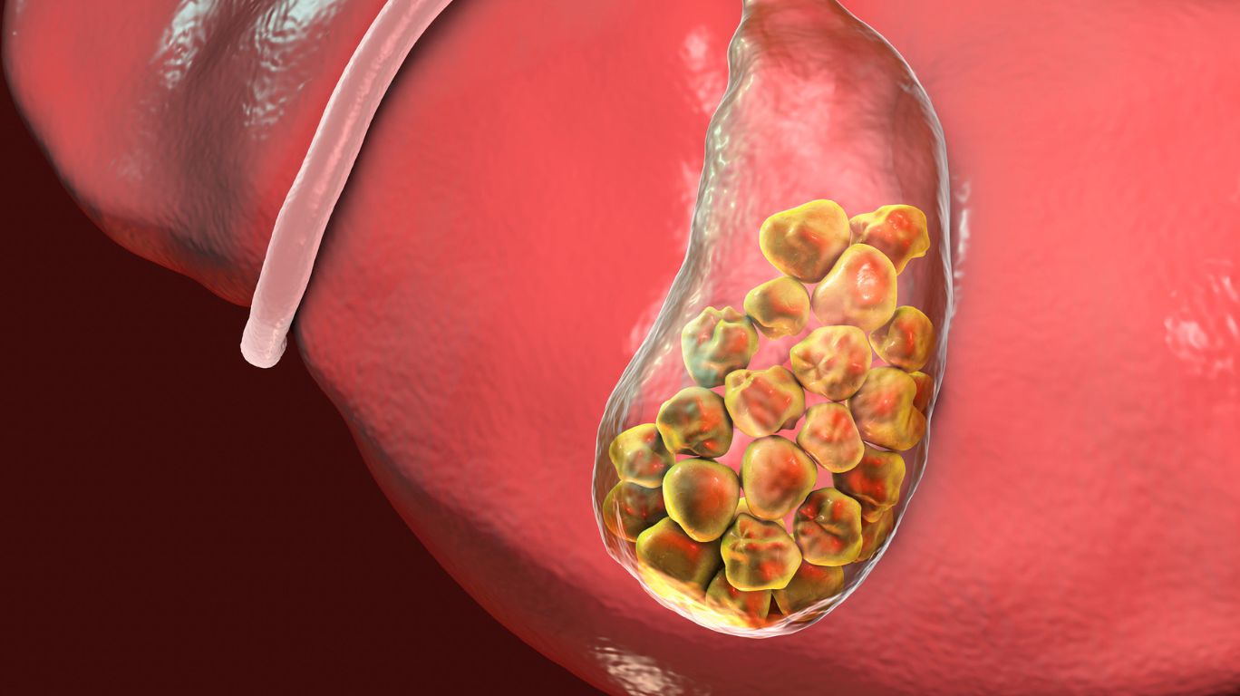 GallStone