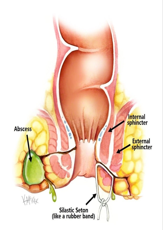 fistula-surgery-treatment-service