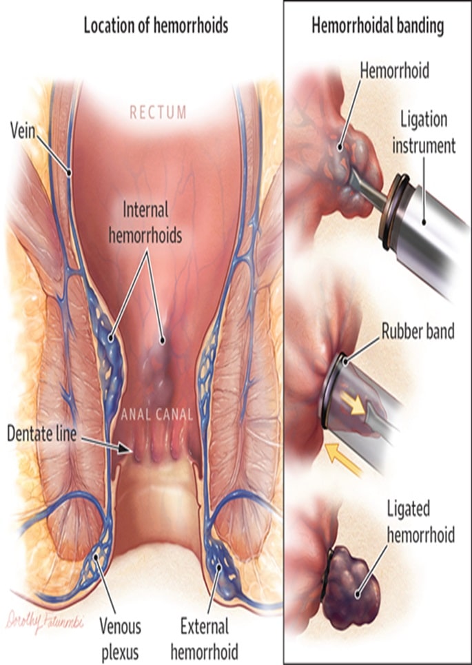 hemorrhoids3