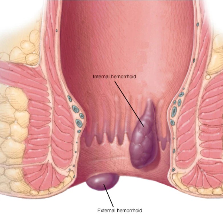 internal and external hemorrhoids