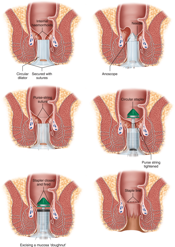 stapler-surgery-of-Hemorides-min