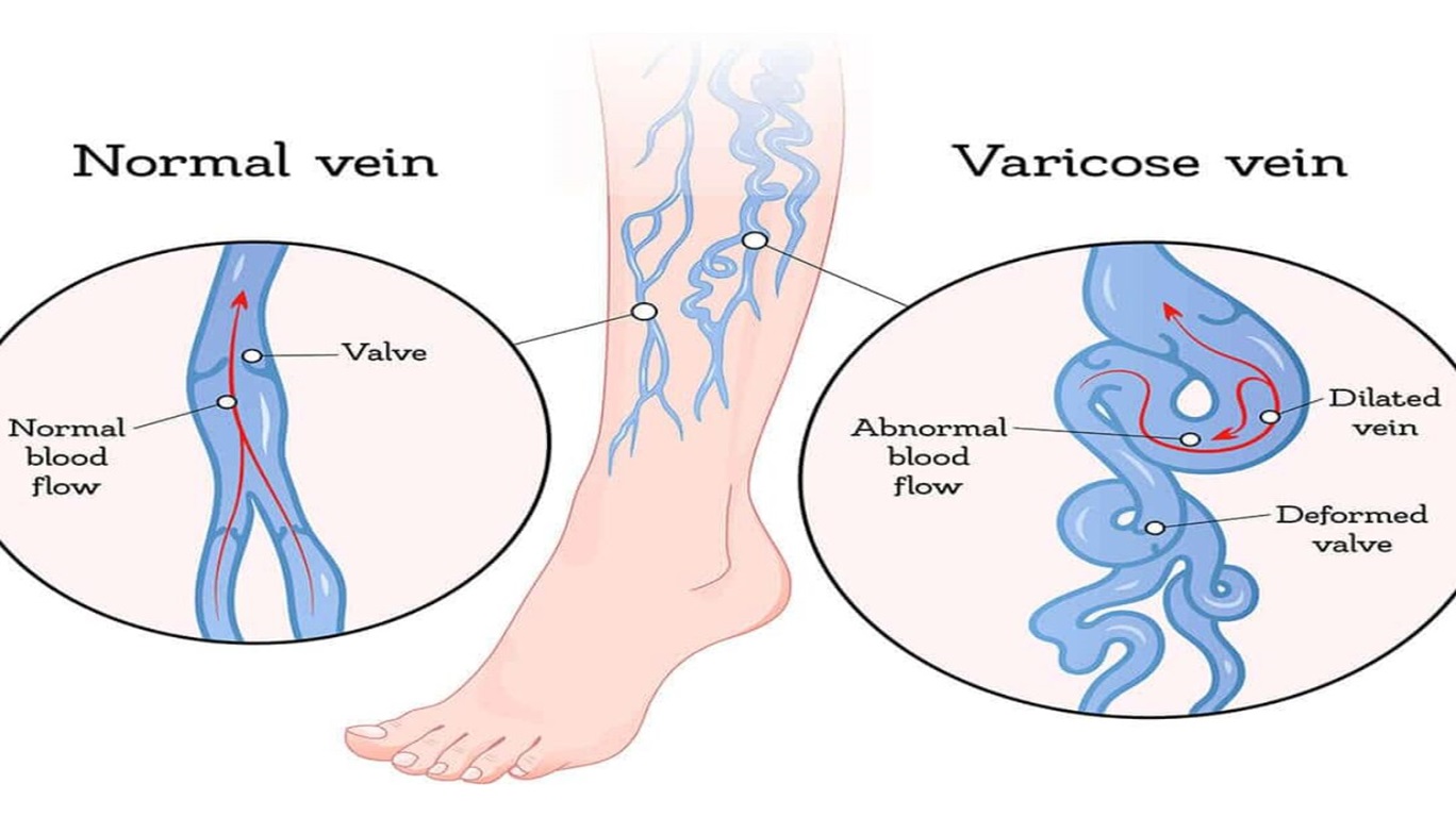 Causes, Effects and Solutions on Varicose Veins