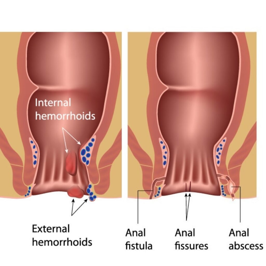 Fissure And Fistula