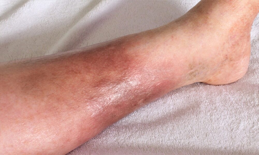 Cellulitis Recovery