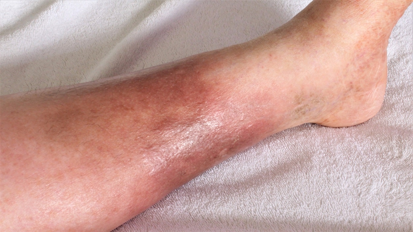 Causes, Effects and the Solution to Cure Cellulitis