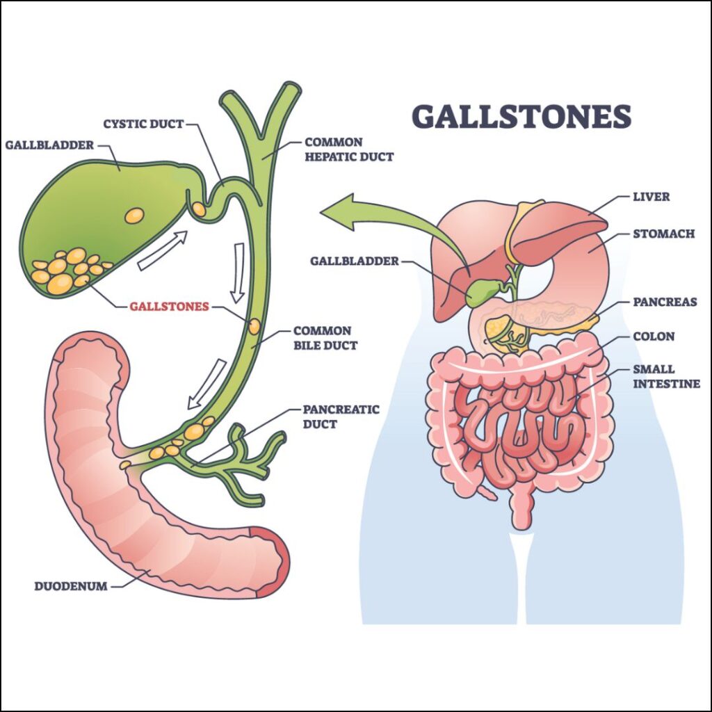 Gallstone Causes