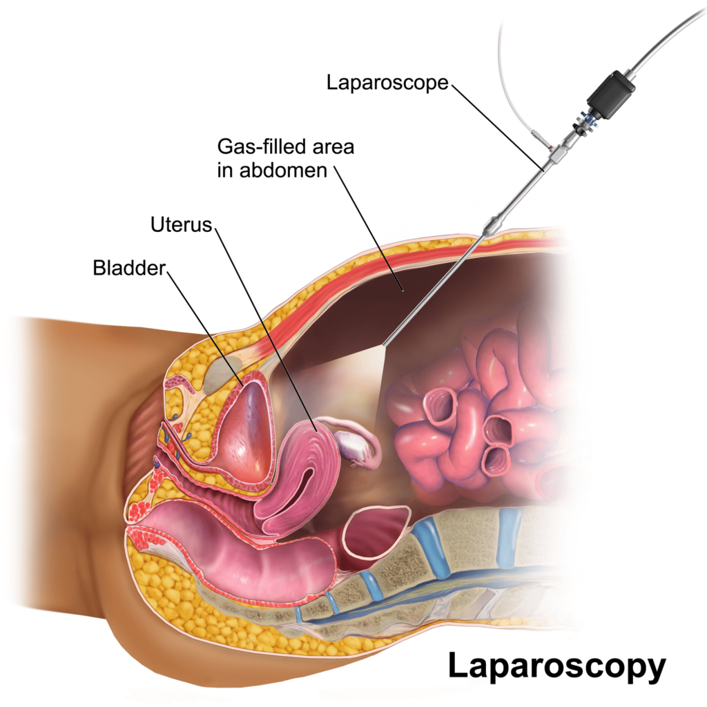 Gynaecological Laparoscopy