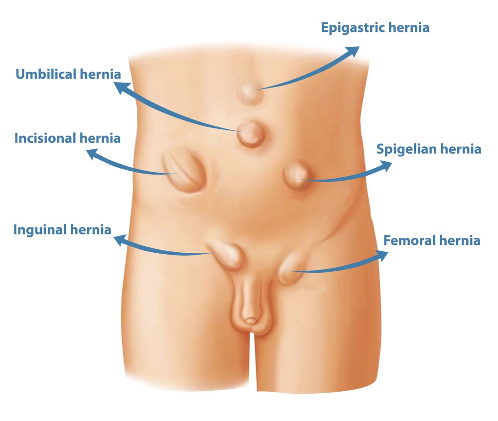 Types-of-hernia