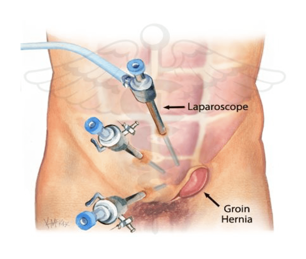 laproscopy hernia Surgery-min